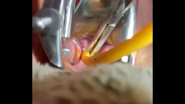 Ferske Inserting Foley into cervix toppfilmer